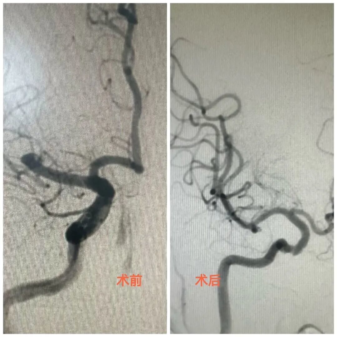 寒冬脑梗高发期!一天两例急救 医生给出关键防护建议