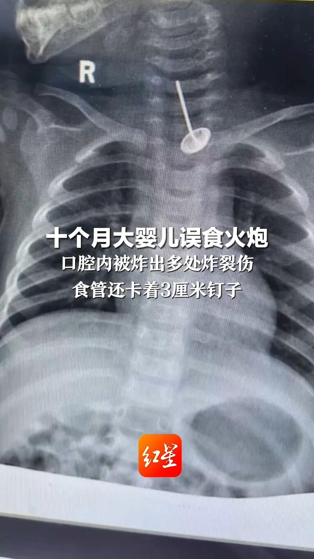 十个月大婴儿误食火炮 口腔内被炸出多处炸裂伤 食管还卡着3厘米钉子 及时送医化险为夷