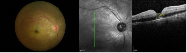 西安市第一医院:“眼动脉溶栓术”助力24岁内蒙患者重获光明