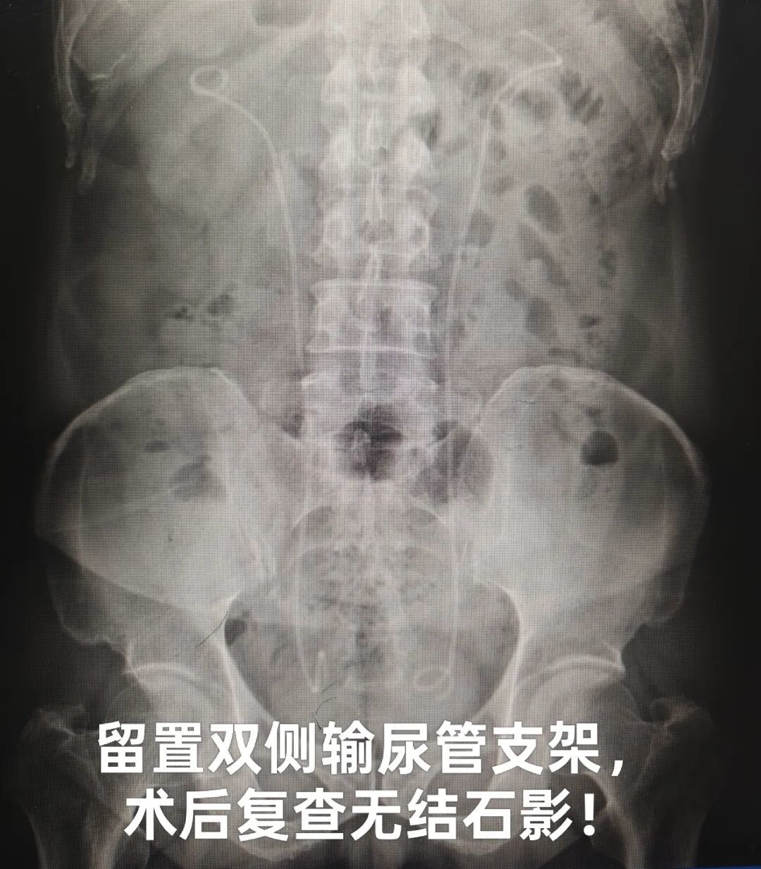 西安市第一医院:巨型双肾结石一次清——“新跃镜”破新局