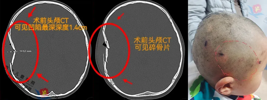 5岁男童摔伤致颅骨重创，江西省儿童医院神经外科妙手化险