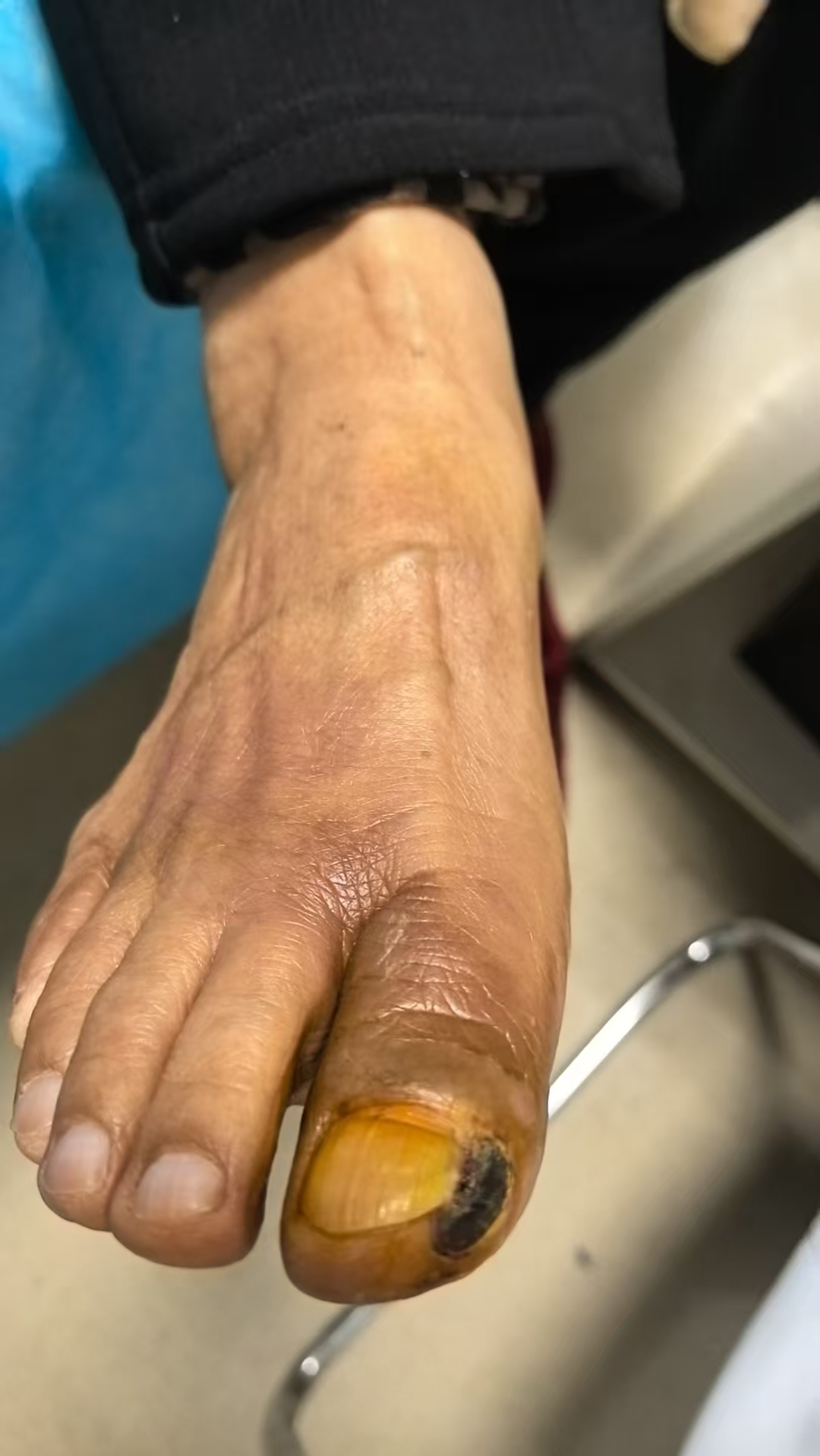 血栓堵塞动脉险酿大祸!血管外科“国家队”微创手术为患者成功保肢