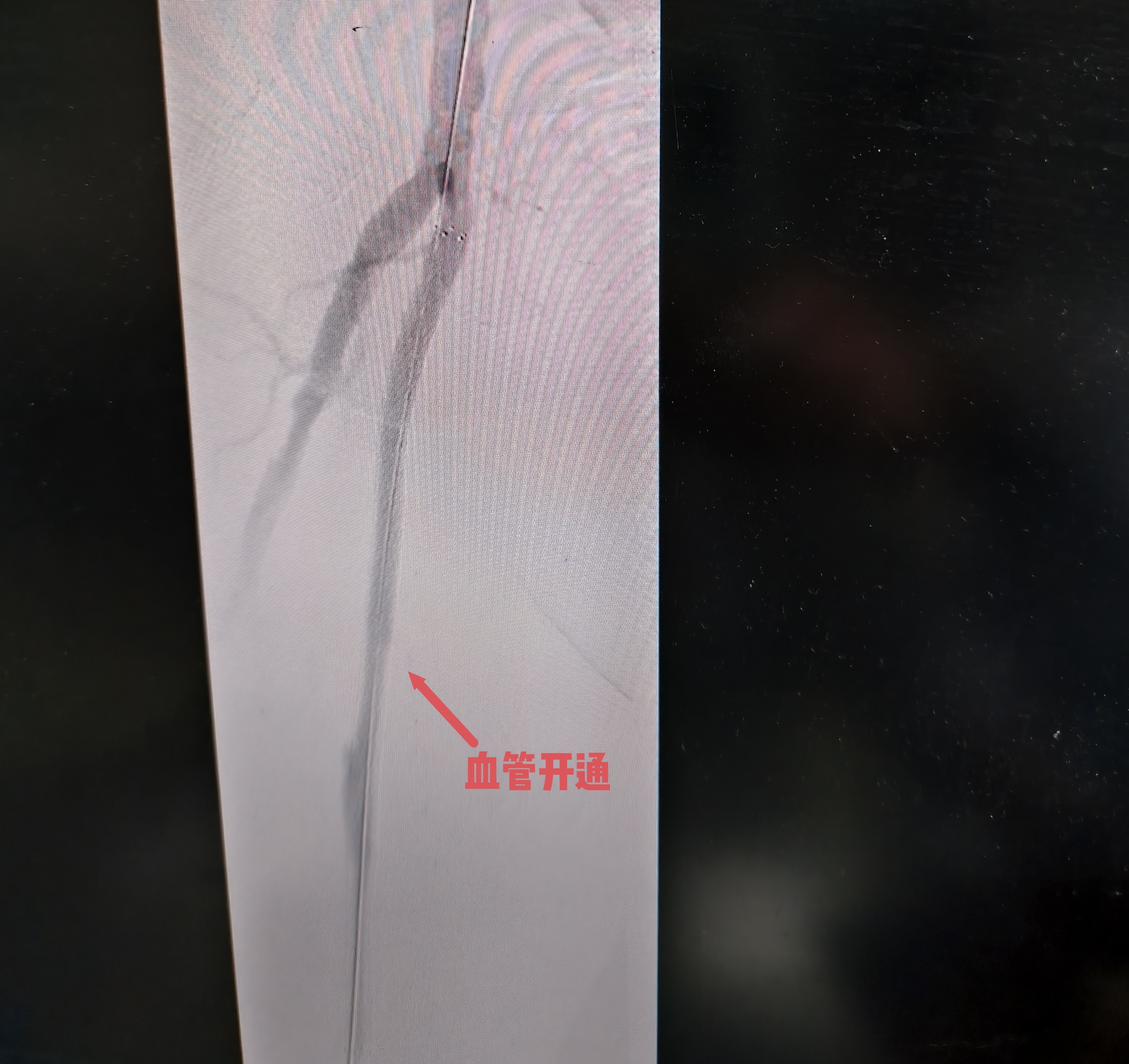 血栓堵塞动脉险酿大祸!血管外科“国家队”微创手术为患者成功保肢