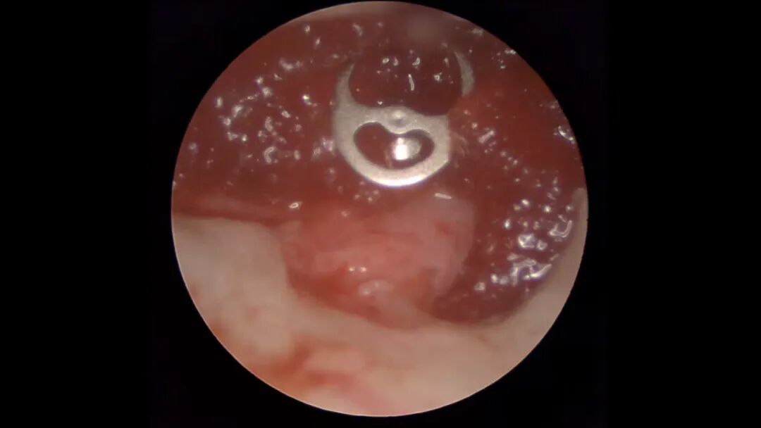 二十年“湿耳”顽疾一朝除，精准手术助老人重获清晰世界