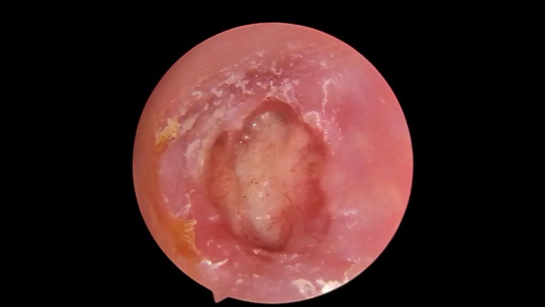 二十年“湿耳”顽疾一朝除，精准手术助老人重获清晰世界