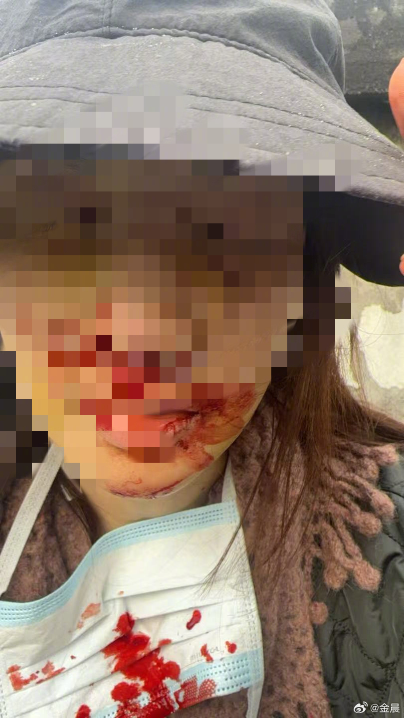 金晨就交通事故致歉,晒出受伤照片