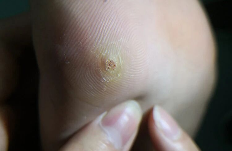 胼胝、鸡眼、跖疣（从左到右）