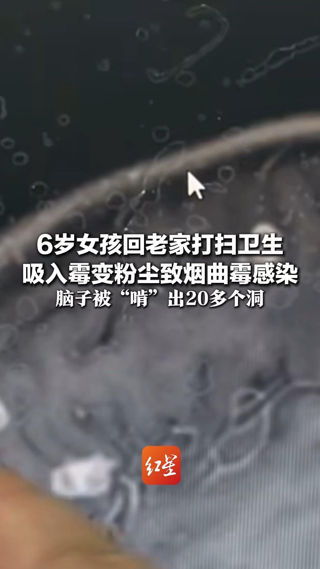 6岁女孩回老家打扫卫生 吸入霉变粉尘致烟曲霉感染 脑子被“啃”出20多个洞 医生提醒：年关扫除注意防护