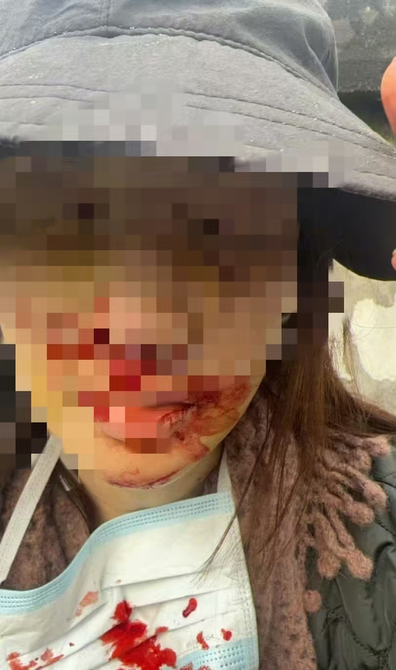 警方通报金晨被曝肇事逃逸，金晨发文致歉：为躲避蹿出小狗撞墙，伤势较重先行就医手术