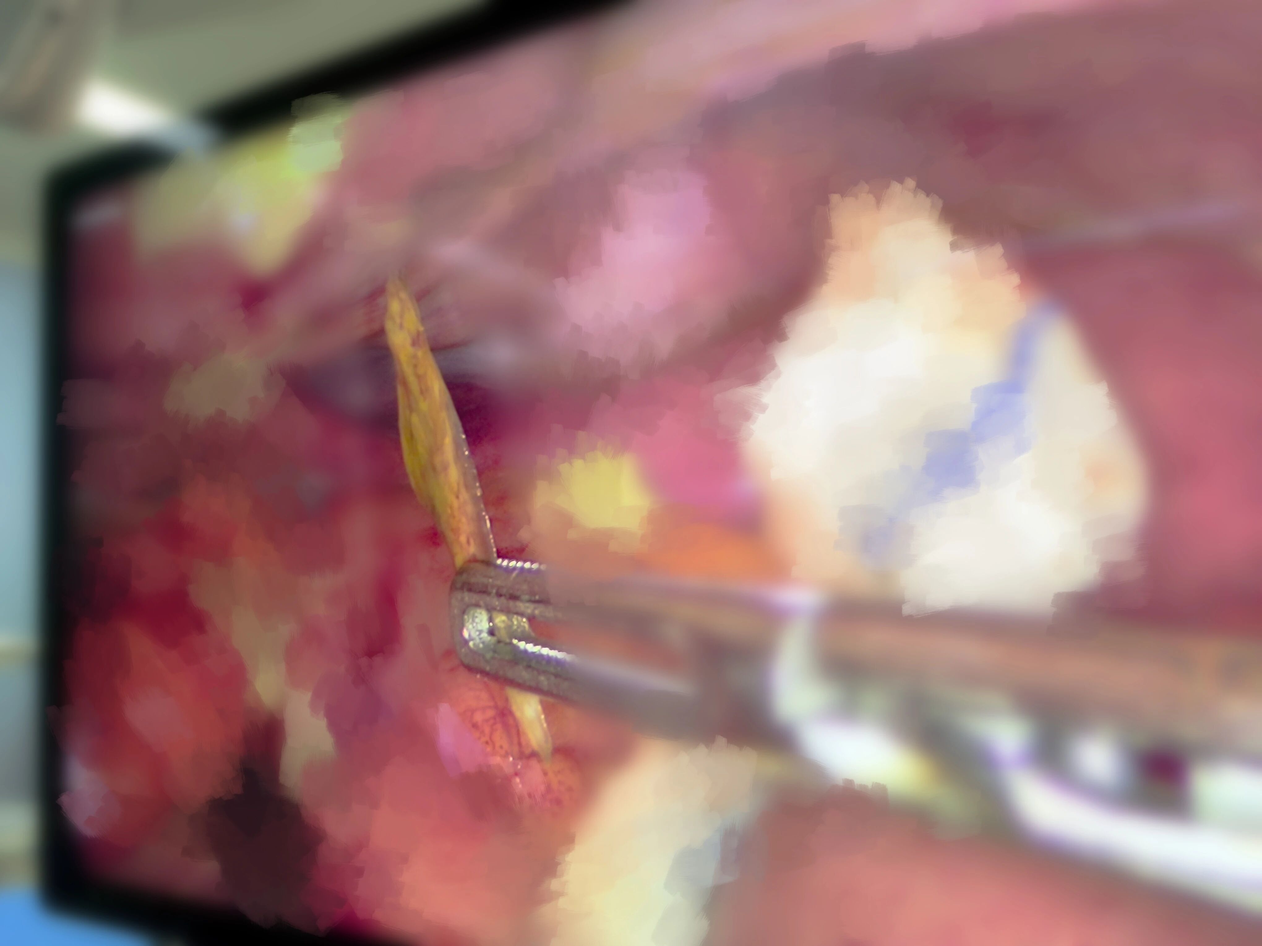 扎破李阿姨乙状结肠的骨片