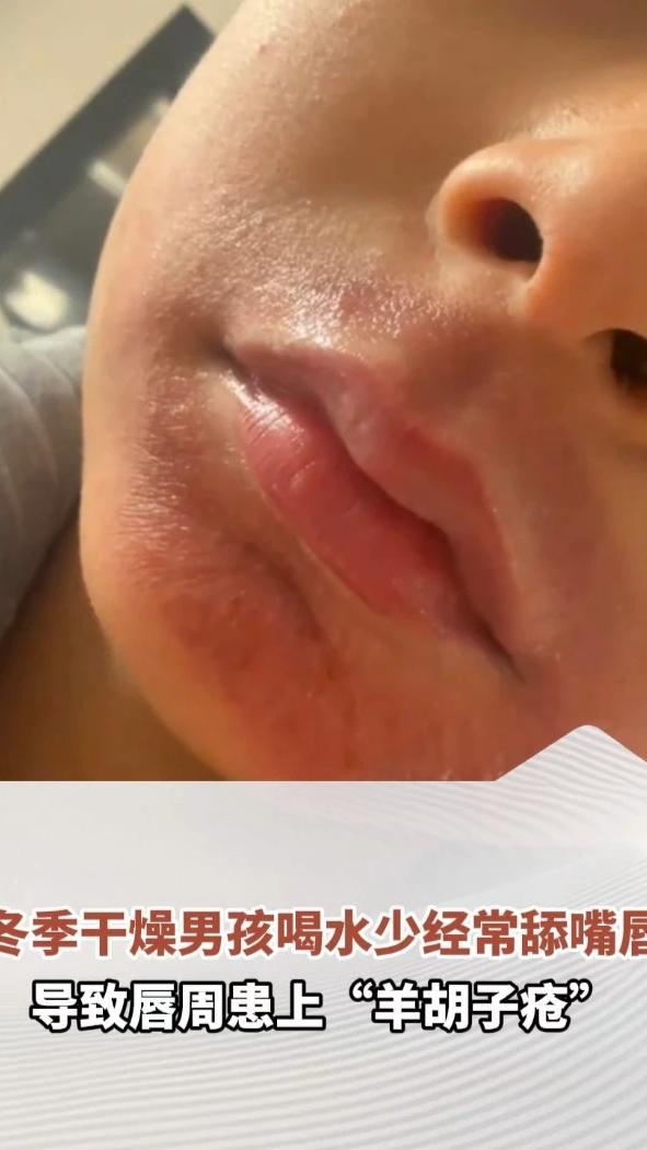 冬季干燥男孩喝水少经常舔嘴唇，“越舔越干，越干越舔”，导致唇周患上“羊胡子疮”