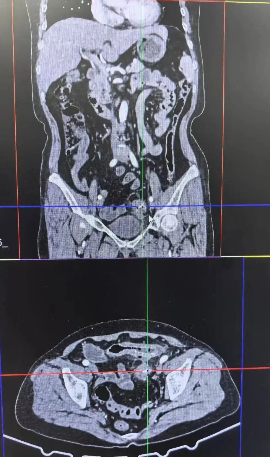 2厘米骨片戳破肠子 医生追问:2天前吃了鱼