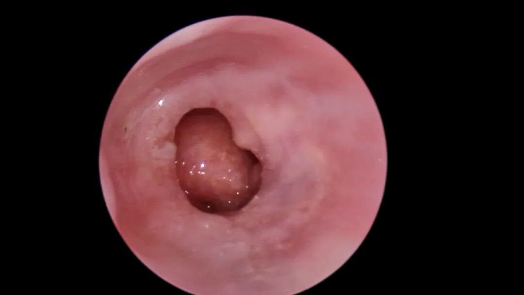 二十年“湿耳”顽疾一朝除，精准手术助老人重获清晰世界