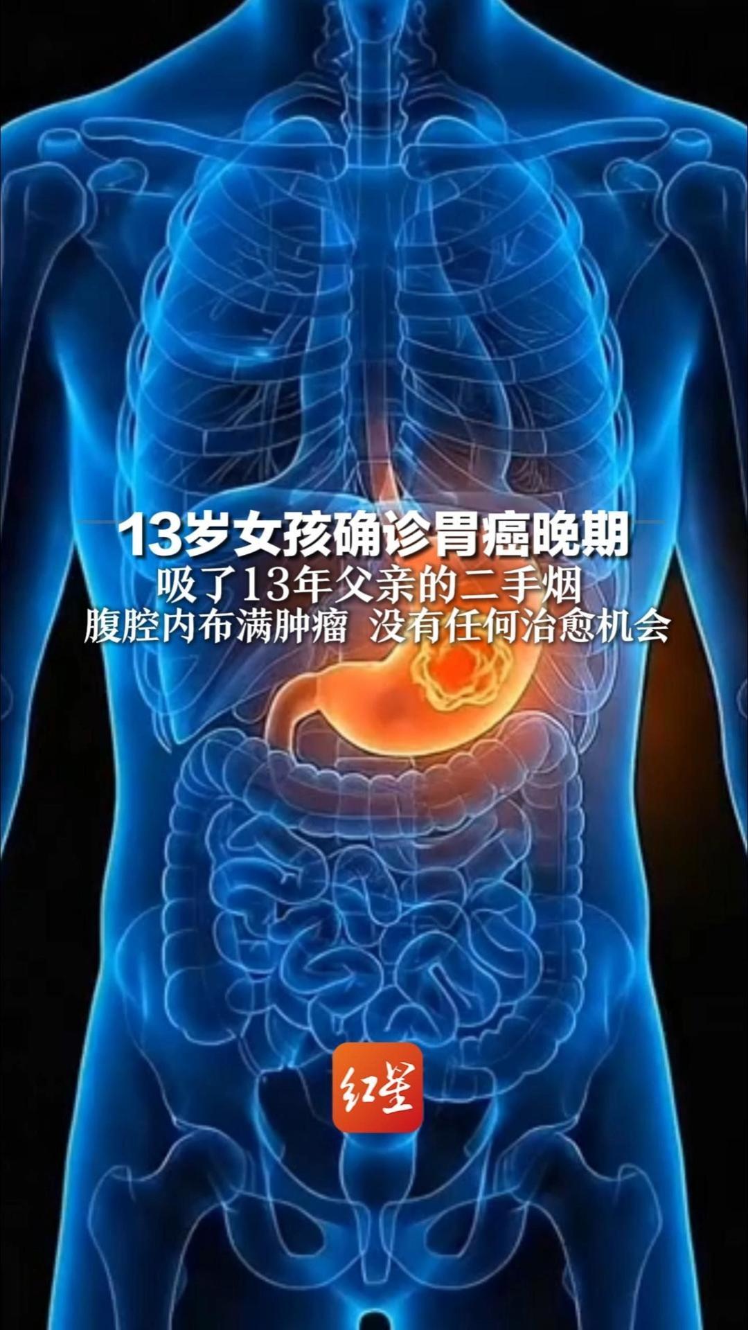 13岁女孩确诊胃癌晚期 吸了13年父亲的二手烟 腹腔内布满肿瘤 没有任何治愈机会 医生提醒：一手烟和二手烟对身体都有害