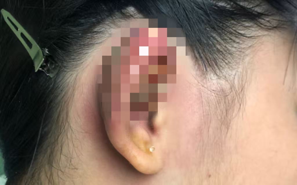 年轻人爱美打耳洞，千万要注意，避免留下终身遗憾
