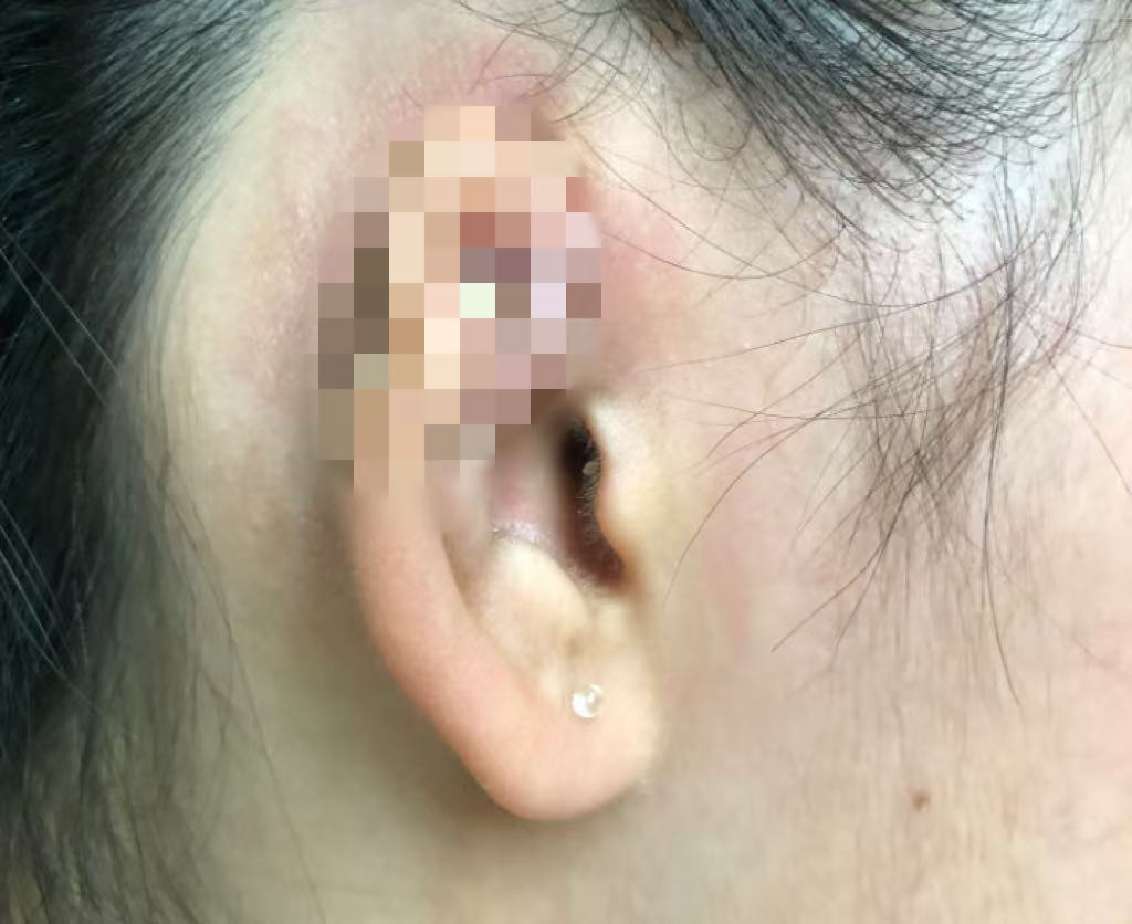 年轻人爱美打耳洞，千万要注意，避免留下终身遗憾
