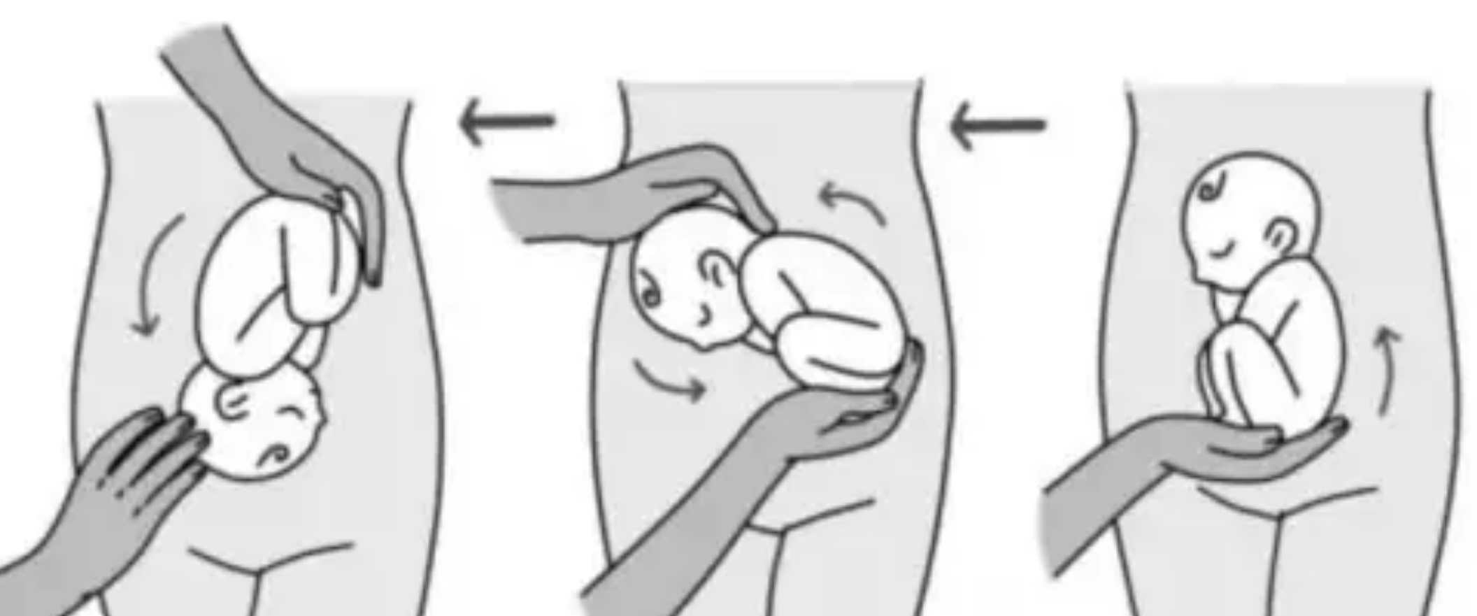 破解臀位难题！龙岗妇幼臀位外倒转团队用硬核医术守护顺产希望