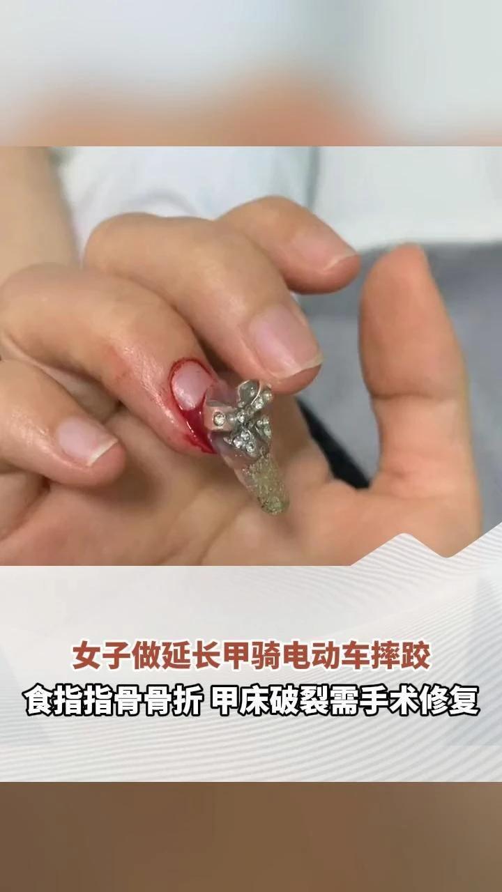 女子做延长甲骑电动车摔跤 食指指骨骨折 甲床破裂需手术修复