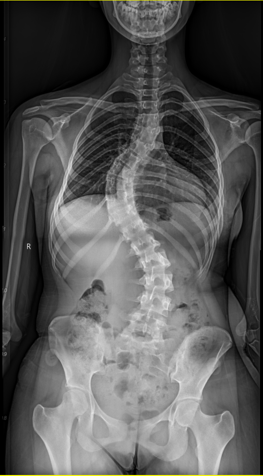 图1 患者侧弯严重 背部畸形明显