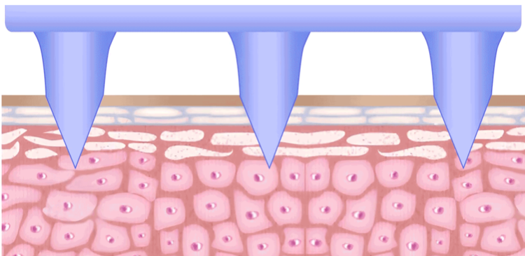 可溶性微针贴的第一名只是起点,华工新颜不是黑马