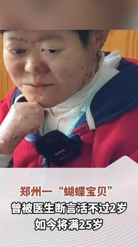 郑州一“蝴蝶宝贝”曾被医生断言活不过2岁，如今将满25岁，母亲：2岁之后的每一天都是赚的