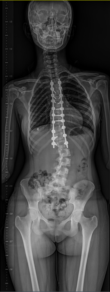 图2 患者术后畸形改善明显