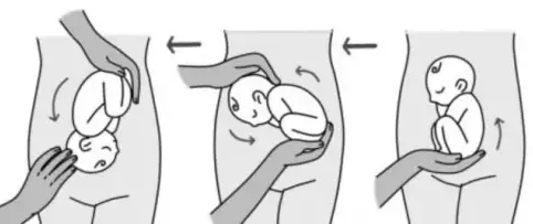 破解臀位难题！龙岗妇幼臀位外倒转团队用硬核医术守护顺产希望