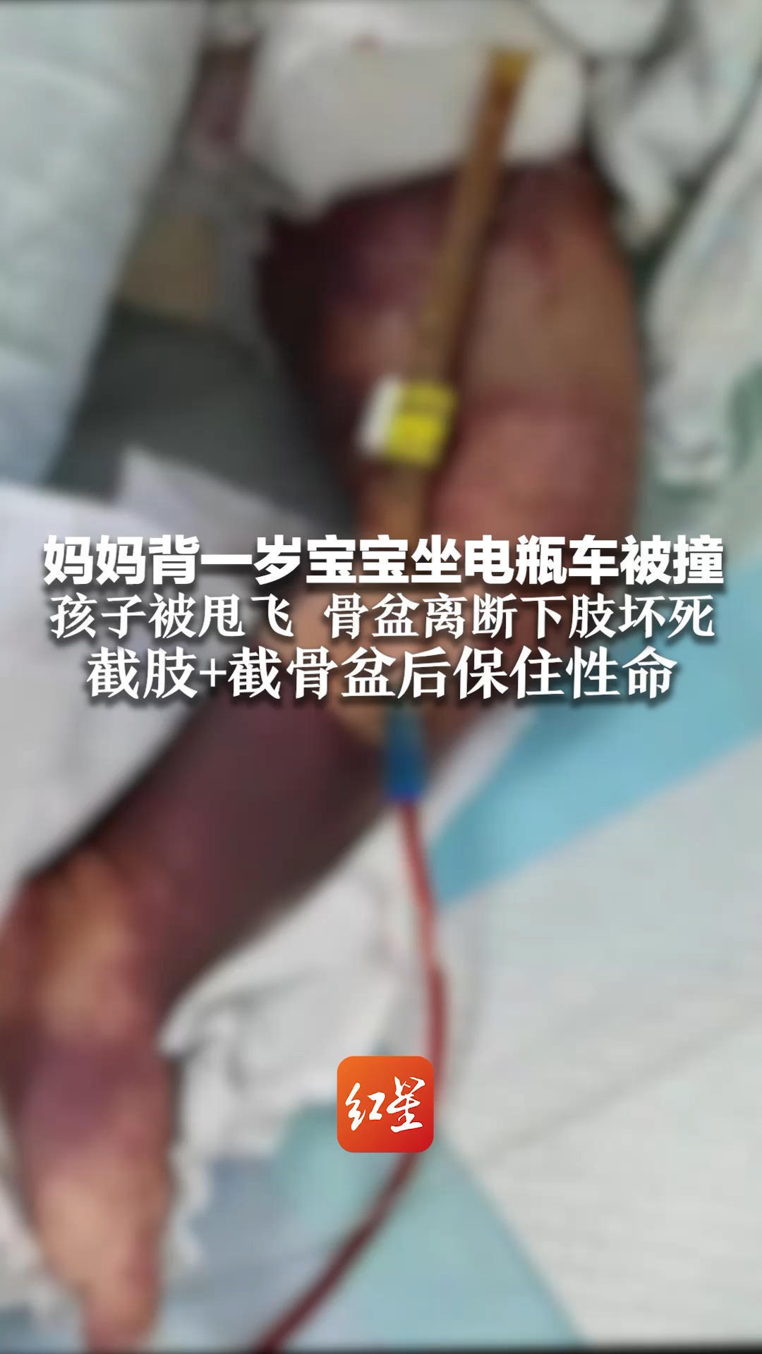 千万别这样带娃出行！妈妈背一岁宝宝坐电瓶车被撞 孩子被甩飞 骨盆离断下肢坏死 截肢+截骨盆后保住性命