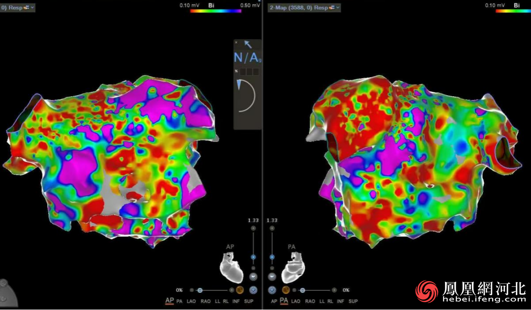 秦皇岛市第一医院成功实施高难度房颤“一站式”手术