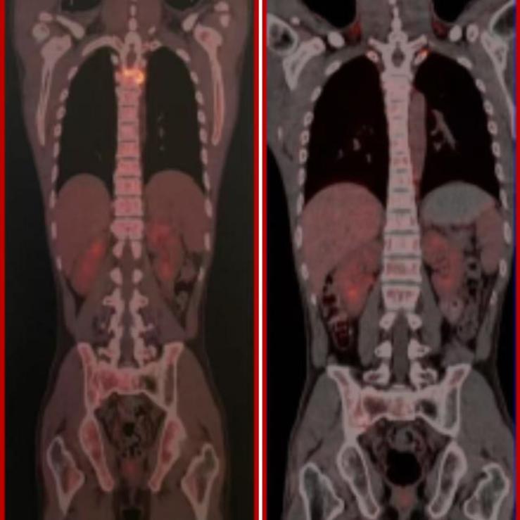图1. 首次CD7 CAR-T细胞治疗及桥接移植后胸椎肿块完全缓解