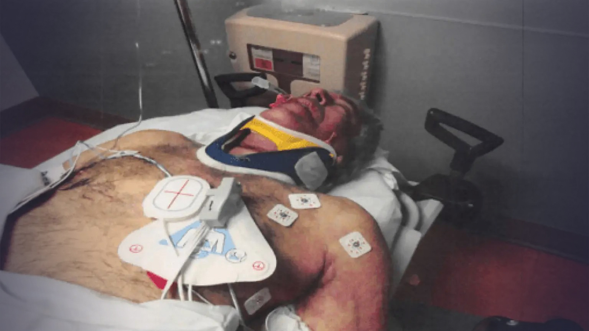 最新！爱泼斯坦“自缢”后照片首度公开：面部红肿骇人，甲状软骨几乎完全折断