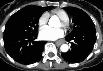 吞咽困难竟是“癌”，达芬奇手术机器人+多学科合作精准拆弹