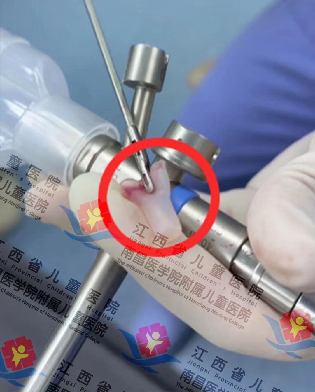 警惕！一个笔帽的“意外”，竟让孩子经历生死10分钟！