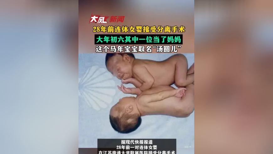 28年前连体女婴接受分离手术大年初六其中一位当了妈妈这个马年宝宝取名“汤圆儿”