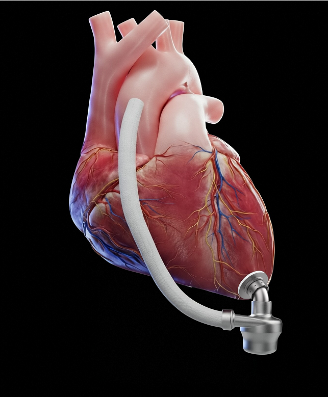 冠军病例｜右心功能不全合并小左室终末期心衰，阜外团队植入LVAD助力新生