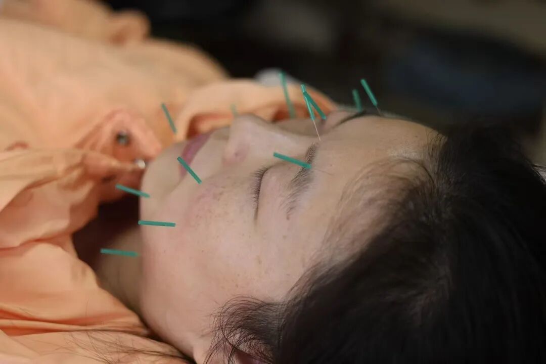 睡眠障碍患者在江西省中医院睡眠医学中心接受中医治疗。