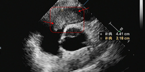 术前影像显示,心腔内粘液瘤已明显增大