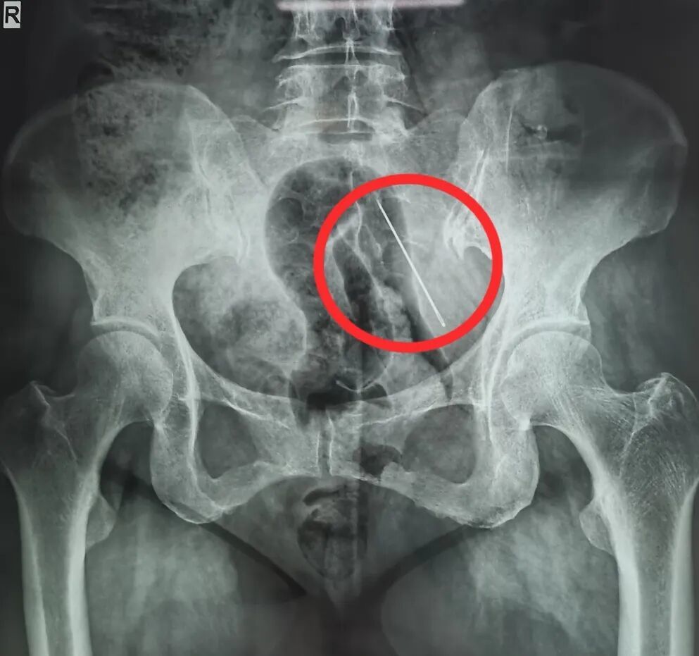 X光片显示张阿姨腹部内有异物