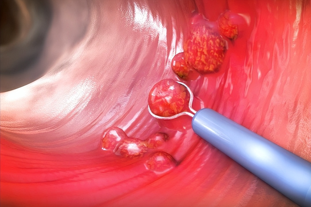 医生调查发现：肠道内有息肉的人，身体一般或可能有这4个特征