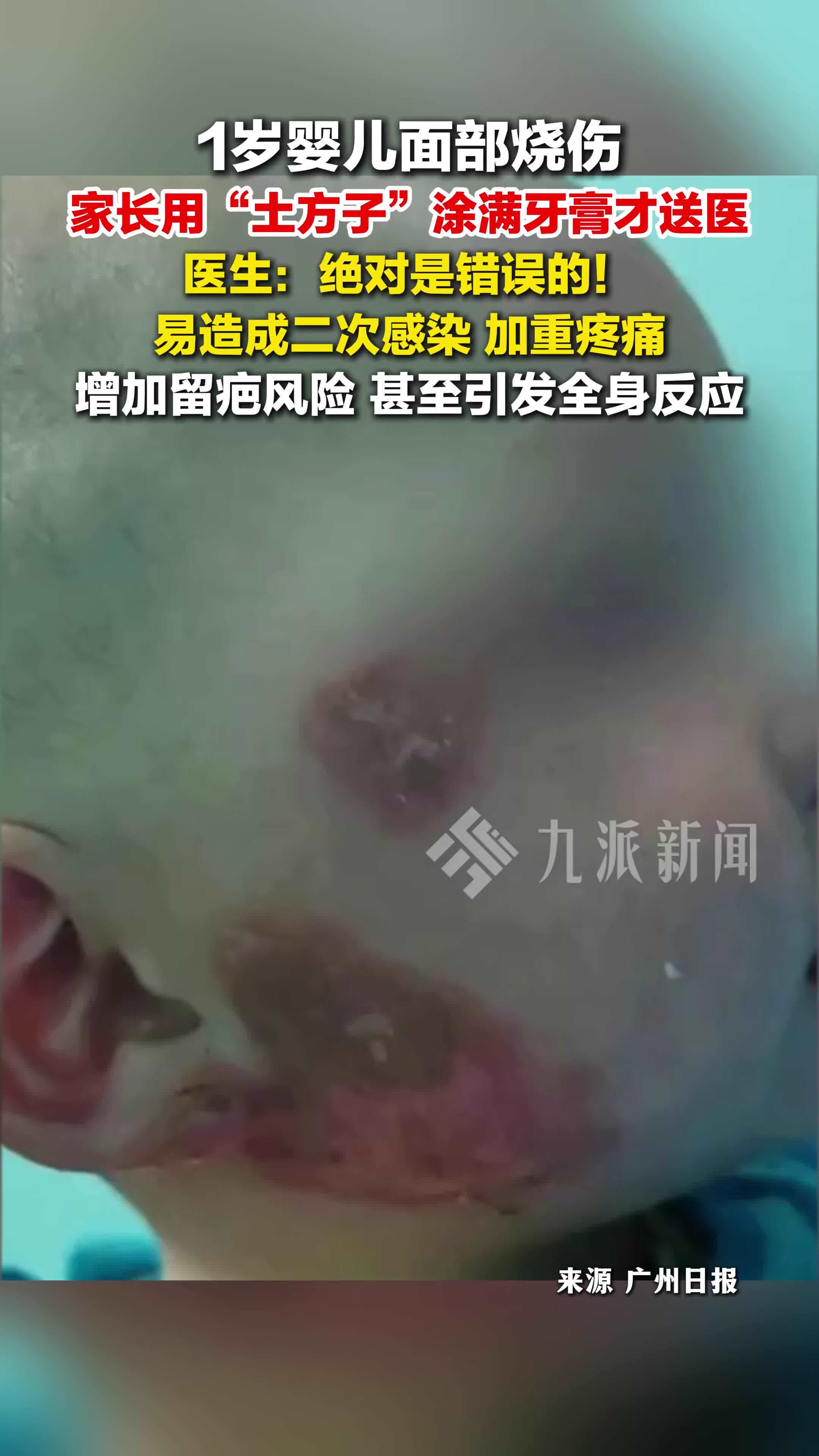 婴儿面部烧伤家长涂牙膏耽误急救，易造成二次感染，增加留疤风险