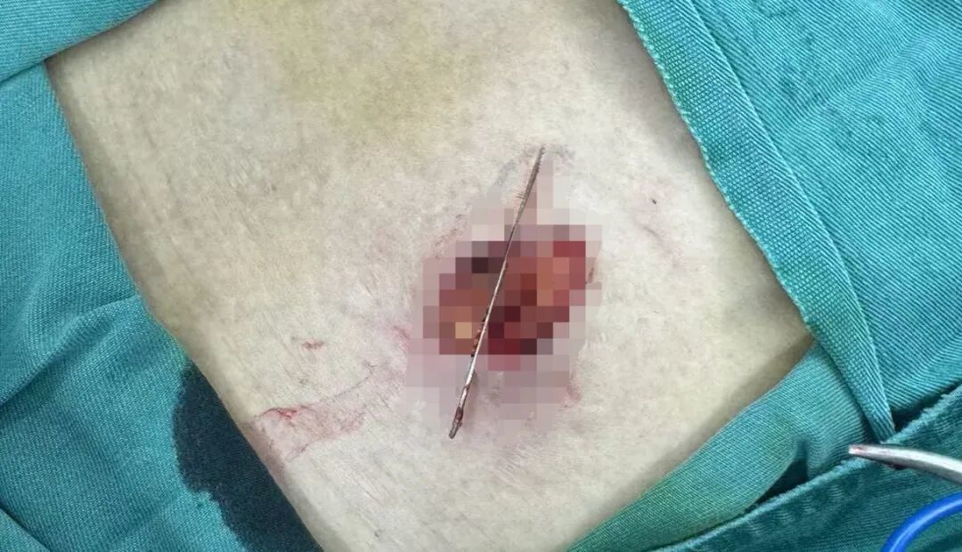 从张阿姨腹部内取出4CM钢针