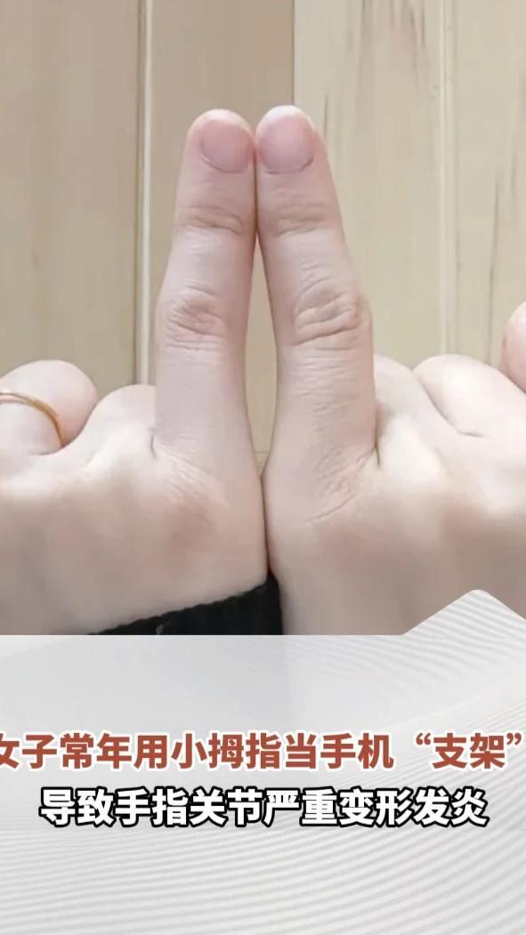 女子常年用小拇指当手机“支架”，导致手指关节严重变形发炎。当事人：治疗的冲击波嗷嗷疼，一定要保护好手指关节