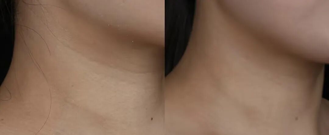 治疗前　治疗后