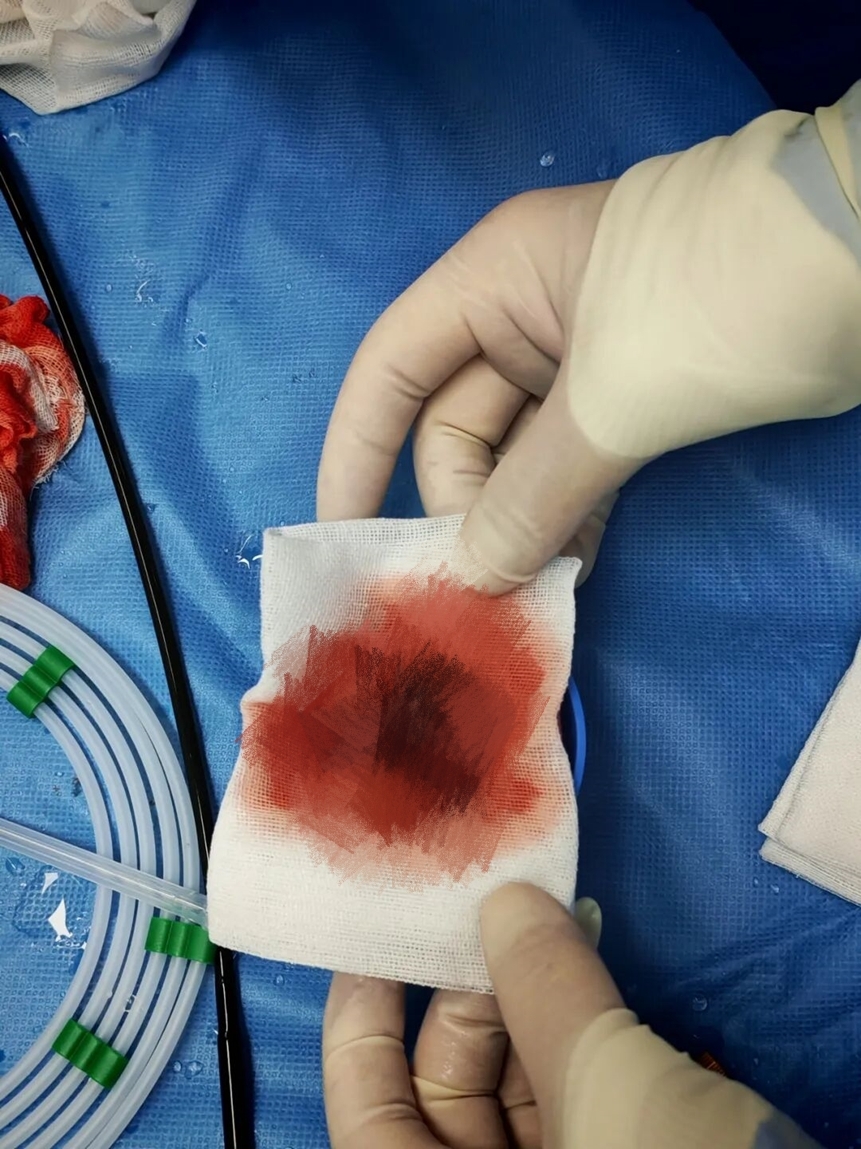 一根输液管差点要了命，胸心外科成功“拆弹”