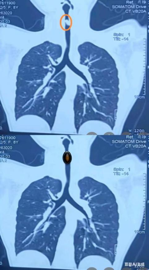 拍片中显示的瓜子位置与AI模拟图 （武汉亚心总医院/供图）