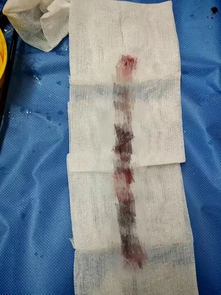 一根输液管差点要了命，胸心外科成功“拆弹”