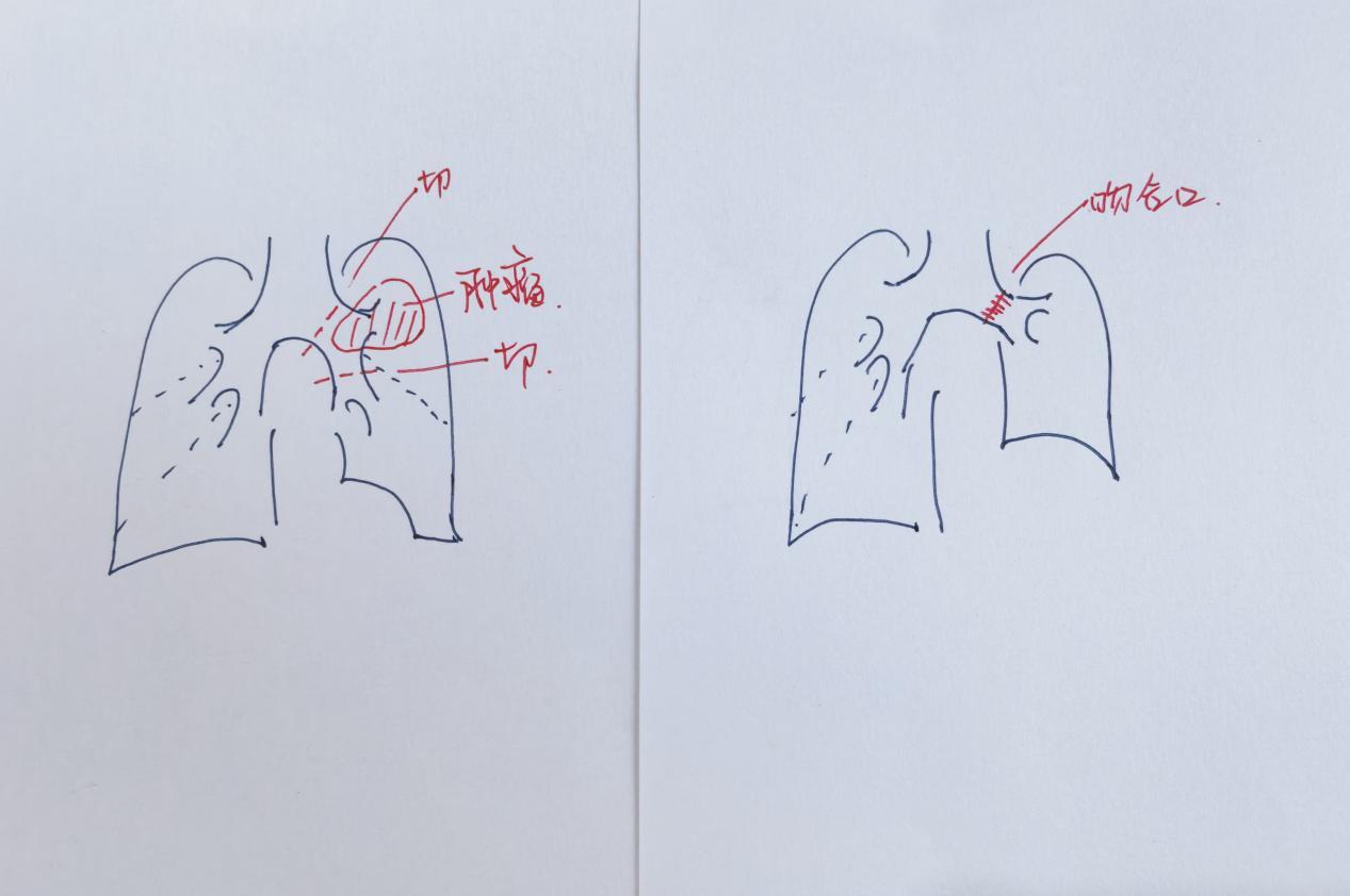 手术及术后示意图