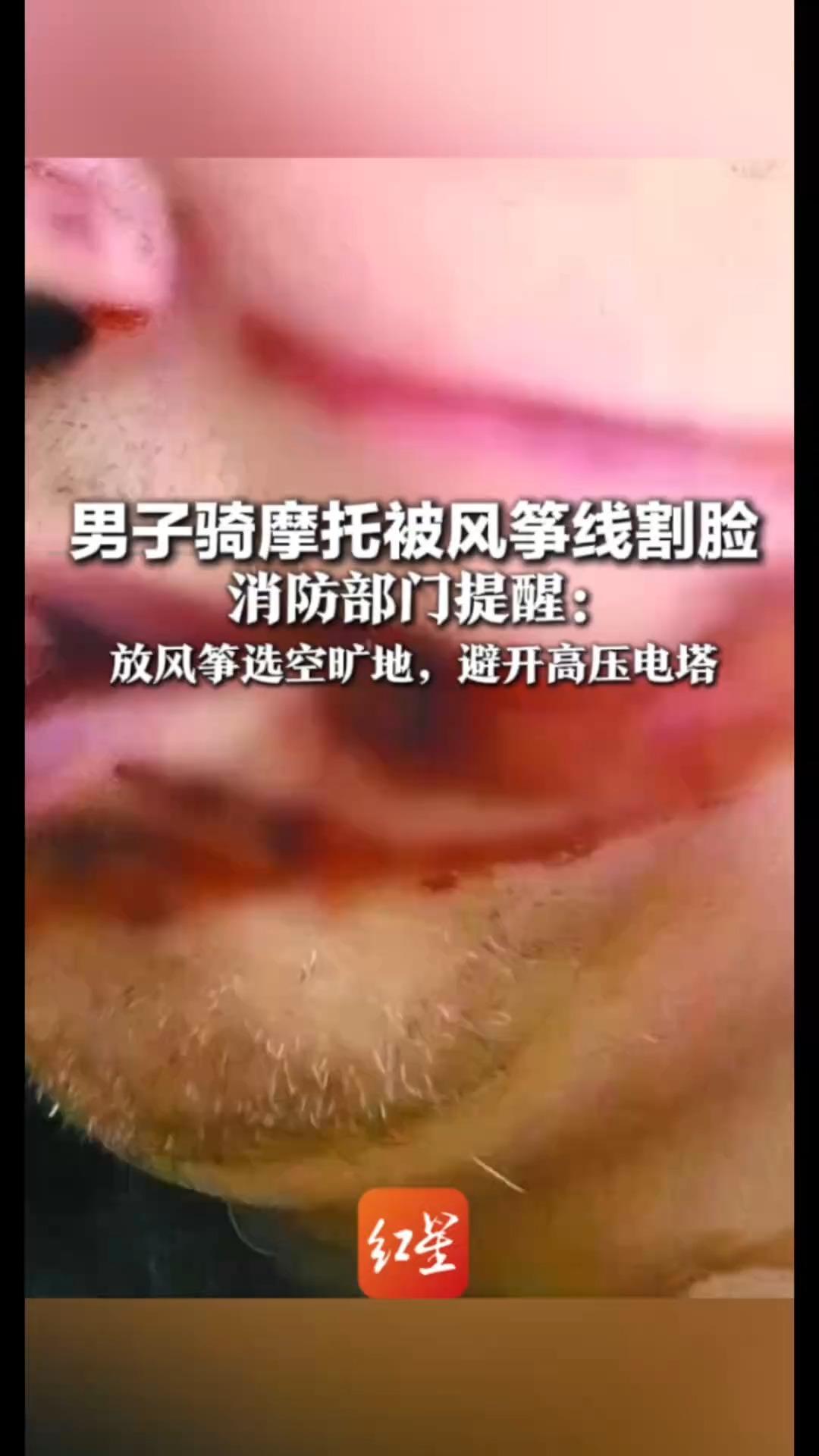 警惕风筝线成隐形“凶器”男子骑摩托被风筝线割脸 消防部门提醒：放风筝选空旷地，避开高压电塔