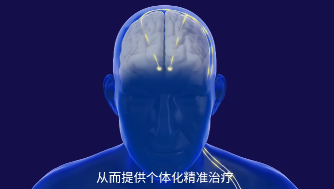 从震颤到奔波，从消极到重生——佛山市一病院用脑机接口技能为患者“重启东说念主生”