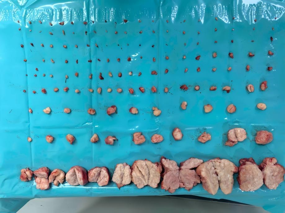 图为PUSH手术从安娜的子宫内剔除的部分肌瘤标本
